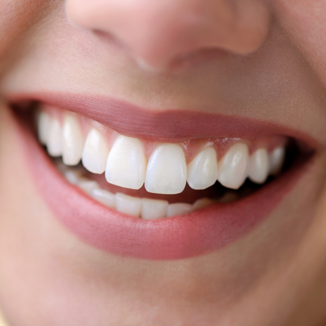 Clareamento dental