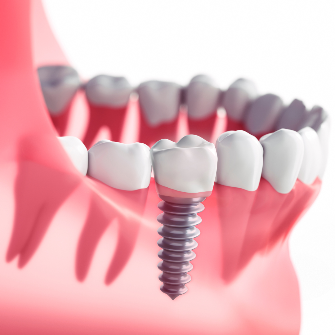 Implantes dentários